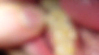 I Tell You About the Fillings in My Teeth and Dental Visits