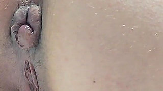 Pissing with a Huge Hemorrhoid in My Asshole Anal Problems