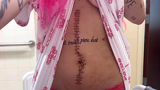Scar Fetishes Stitches Staples Hospital Recovery After Surgery Teen Petite Small Waist