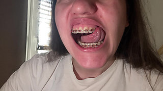 Licking Your Braces with Your Tongue